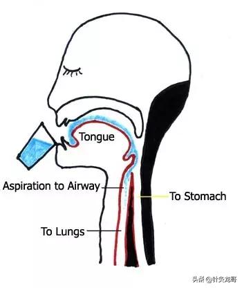 脑干梗死恢复期能做针灸吗,脑干梗塞胃出血怎么办