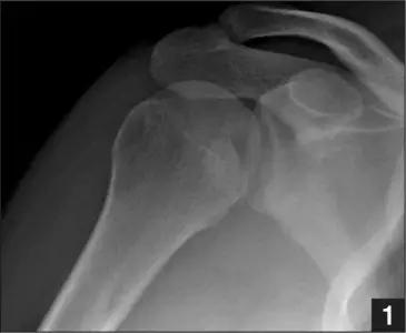 所有骨折都叫什么名字,骨折的名称有哪些