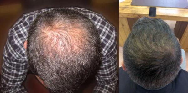 踢球对脱发有影响吗,踢球会使头发变多吗