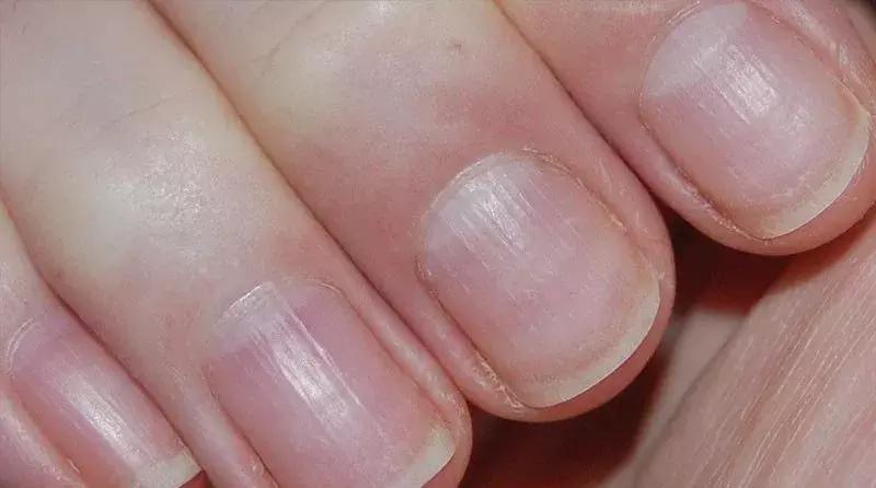 宝宝指甲月牙少有白点怎么回事,宝宝指甲出现空甲现象怎么办