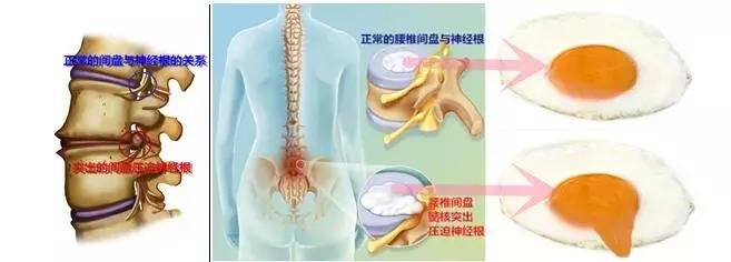 腰椎间盘突出症误区,腰椎间盘突出症的十个关注事项
