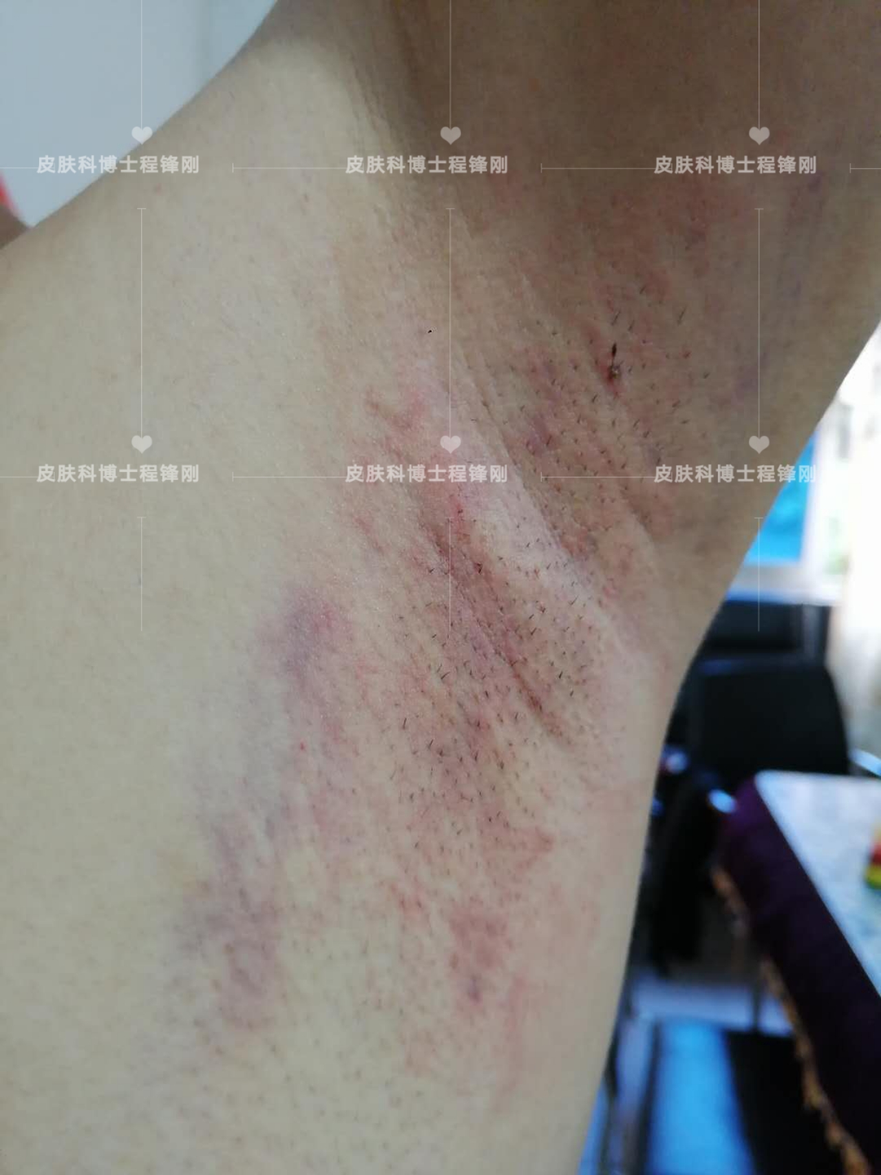 十七岁同学有遗传腋臭最好办法,男性有狐臭后代遗传的概率多大