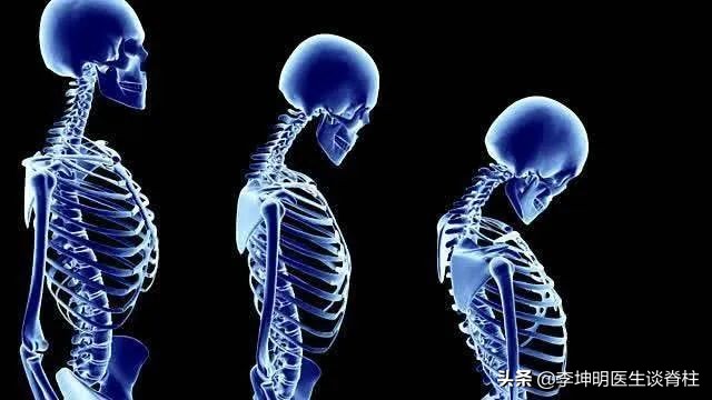 李坤明医生提醒你：颈椎相关疾病的治疗和预防,二）颈椎病（1）