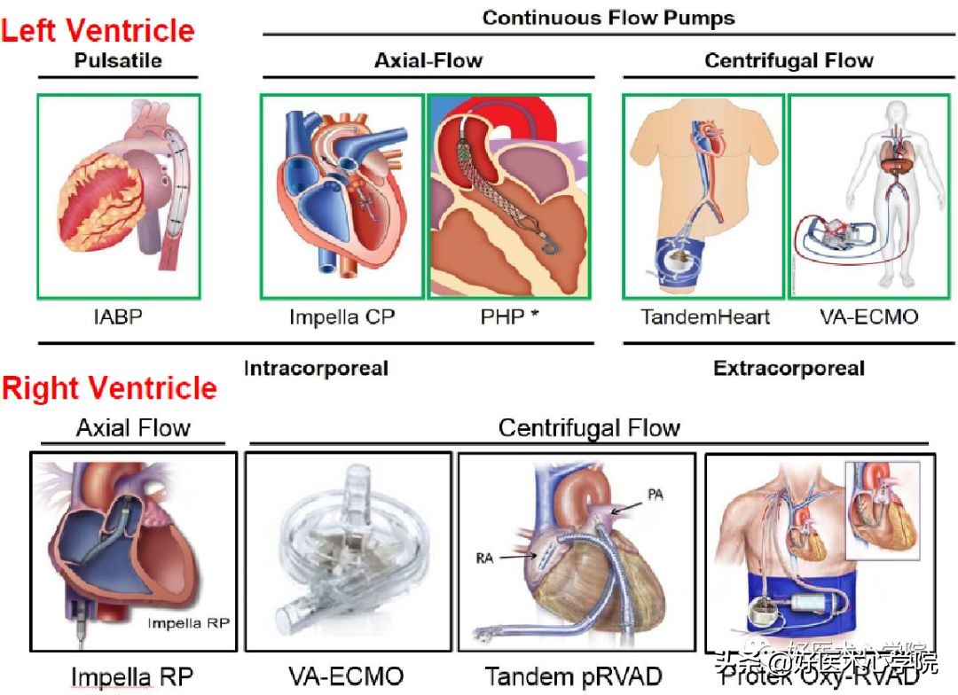 安贞医院冠心病介入治疗新技术,冠心病介入术
