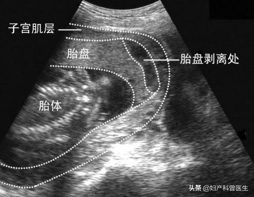 《大江大河》宋运萍轻轻一摔“一尸两命”，产科医生道出了实情