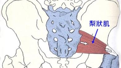 坐骨神经梨状肌综合征是什么意思,坐骨神经梨状肌综合征怎样治疗