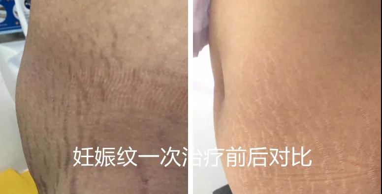 南通冰点脱毛哪家医院好,南通美容医院脱毛