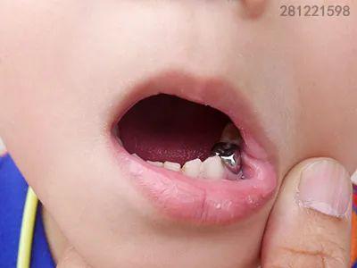 大连齿医生口腔科普想补牙？最好先了解一下这些补牙材料