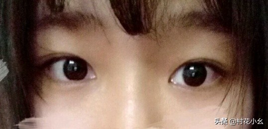 谁知道做双眼皮效果最好的医院,割双眼皮需要问医生哪些问题