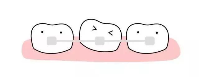 牙齿矫正必须先拔掉智齿嘛,牙齿矫正一定要先补牙吗