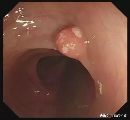 只要是肠息肉都要割掉吗,医生肠息肉切除后怎么处理伤口