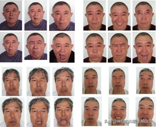 上眼睑无力老是提眉,一侧抬眉引起轻度肌无力能恢复么