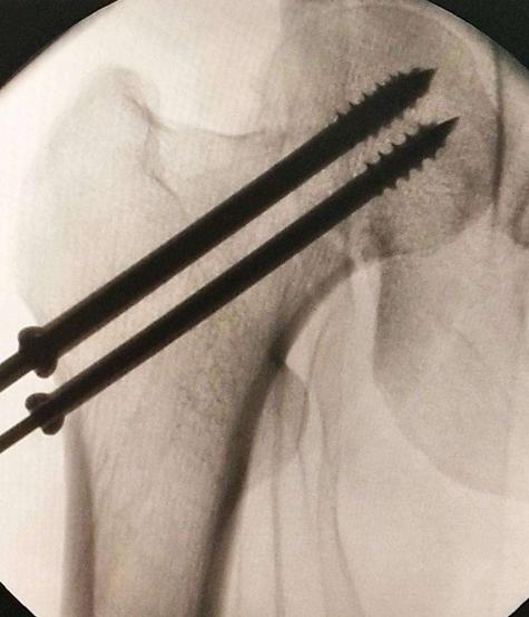 青少年股骨颈骨折影响腿长,少年股骨颈骨折能完成治愈吗