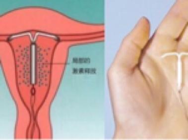 带环后还要采取其他避孕措施吗,带环后大出血怎么回事