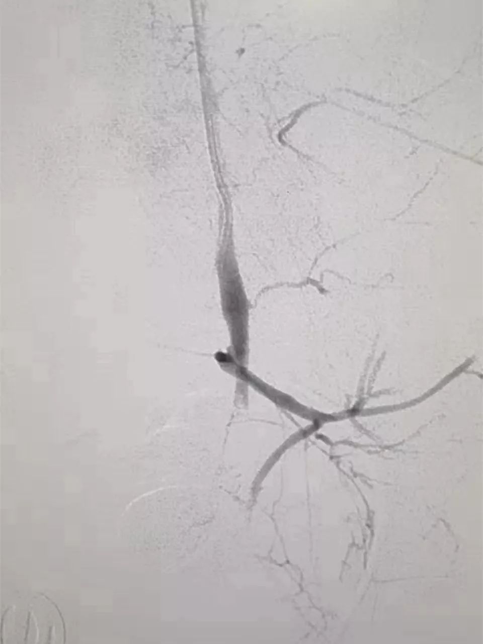 孕妈产后大出血,孕妇产后大出血助产士抢救过程