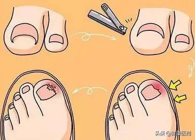 指甲有甲沟用什么指甲剪好,指甲剪能剪破皮吗
