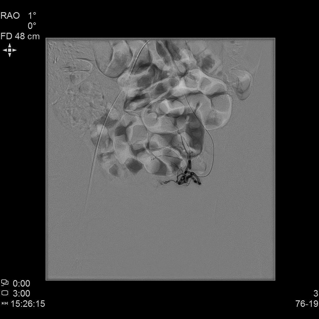 子宫腺肌症称为不死的癌症,子宫腺肌症是不死的癌症吗
