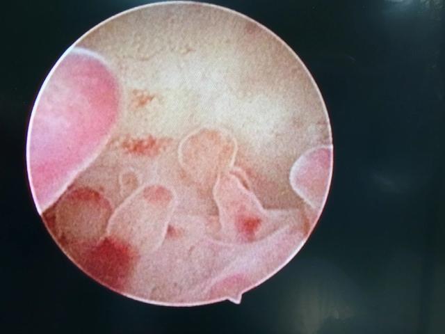 宫腔镜腹腔镜动画,宫腔镜和腹腔镜检查全过程