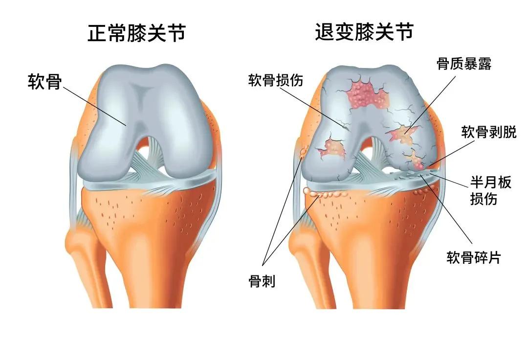 老寒腿是因为没穿秋裤吗,天冷了记得穿秋裤不然冻成老寒腿