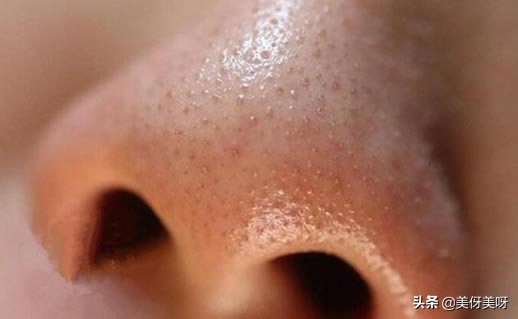 人为什么会长黑头求解：黑头白头的成因及结构和去除方法