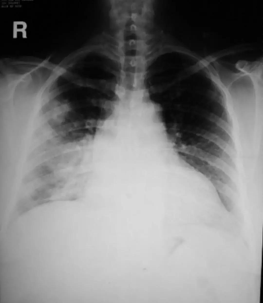 感染性疾病主要检测流程,感染性疾病筛查怎么做