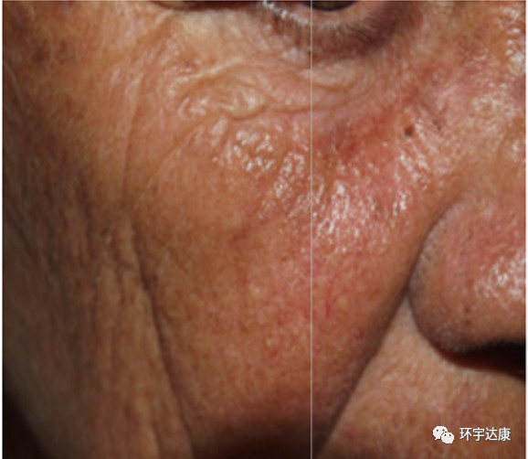 古巴癌症疫苗效果怎么样,古巴研究出癌细胞疫苗