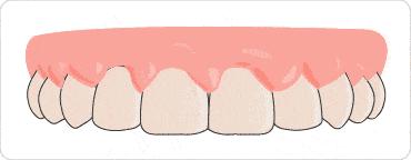 戴牙套黑三角可以恢复吗,戴牙套的黑三角可以恢复吗