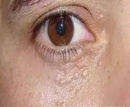 长了这么多年汗管瘤，你还以为是脂肪粒？