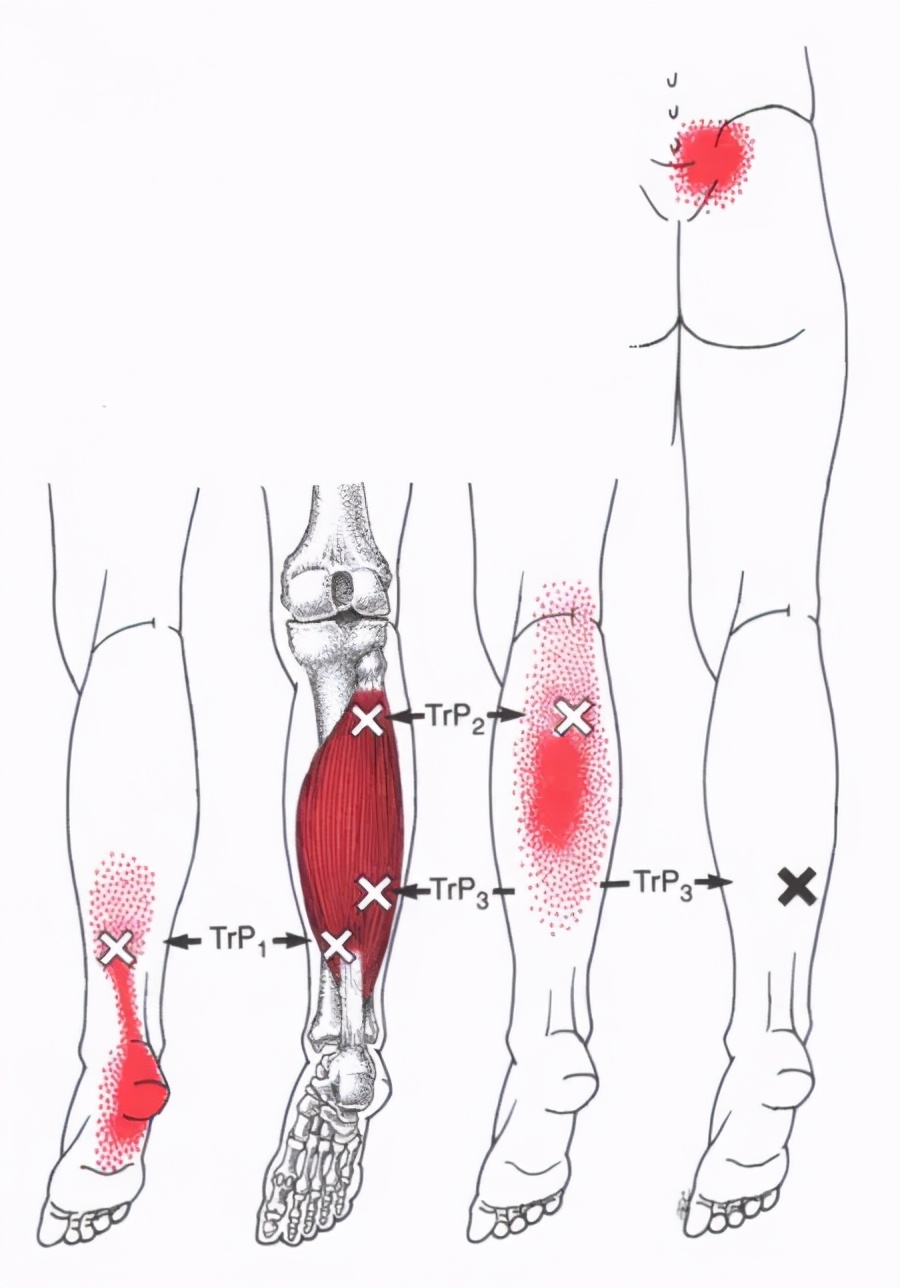 康复训练手法干货分享,康复治疗师肌肉