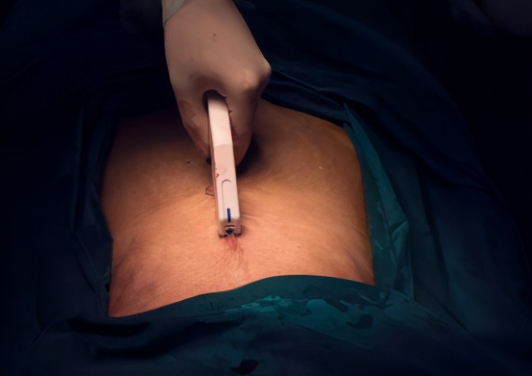 剖腹产妈妈，面临的五大“关卡”，宝爸怎么做才能陪宝妈顺利度过