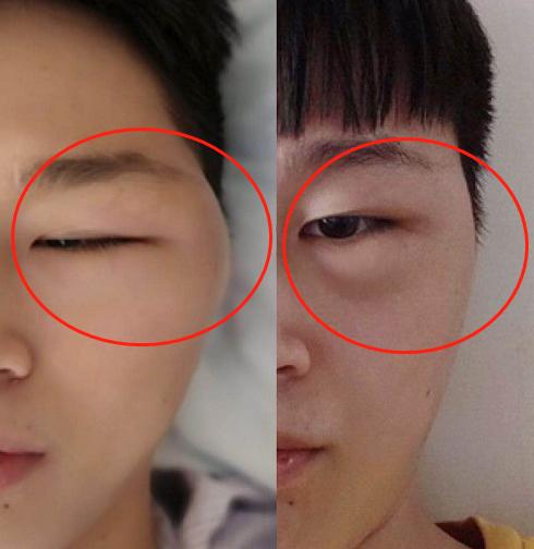 血管畸形什么时候能根除,血管畸形什么时候治疗