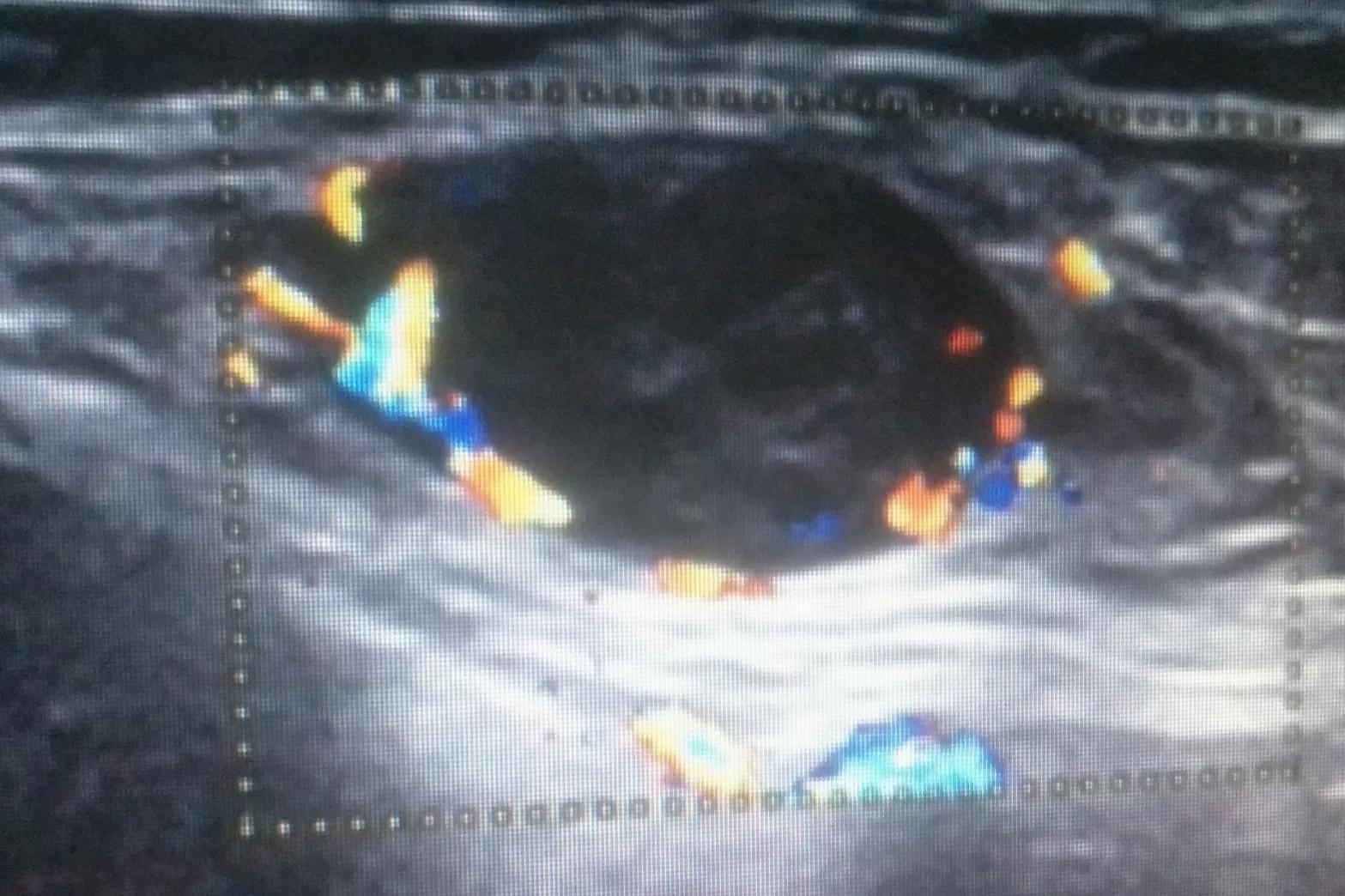 29岁的抗癌之路,26岁胃癌晚期死亡