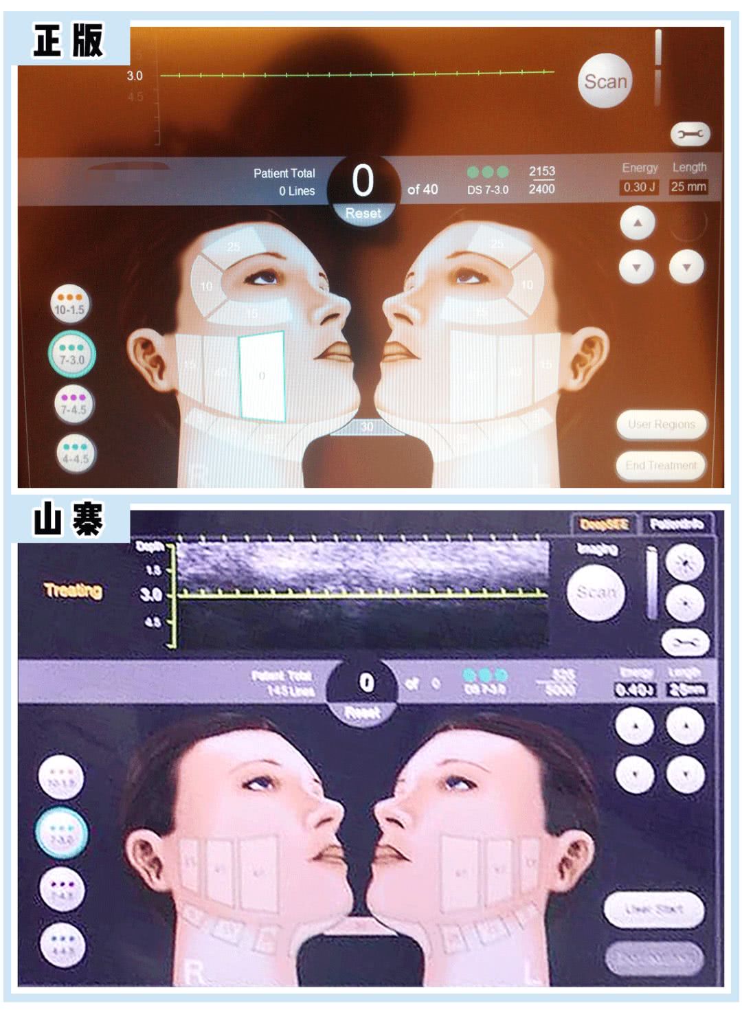 张雨绮说做超声刀就像在烤肉？我去体验了一把……