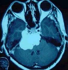 张医生治病救人后续,左眼皮一直跳咋回事好像痉挛