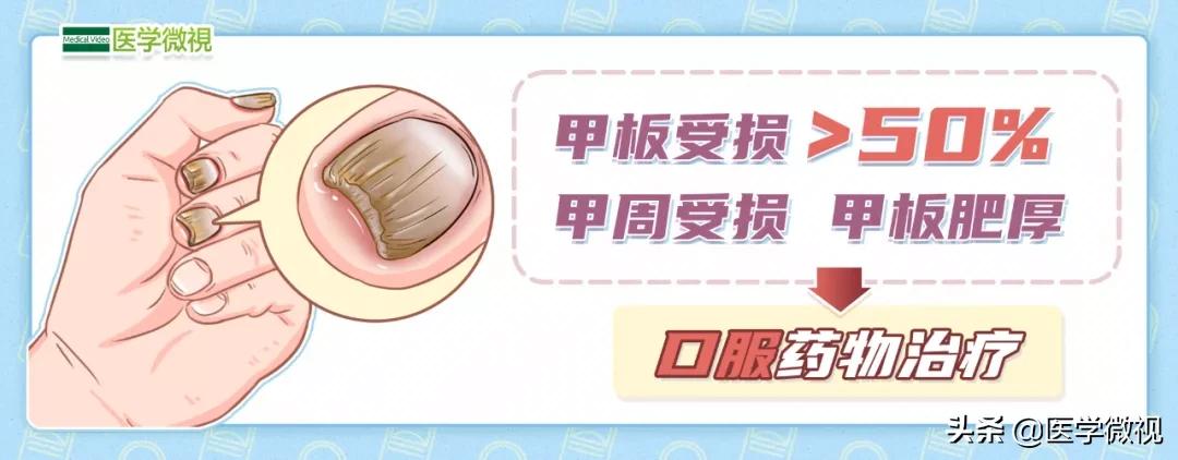 灰指甲三年没治好怎么办,大脚趾灰指甲口服了半年药不见好