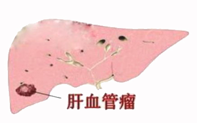 肝上长瘤吃啥药治病,肝上长瘤用什么药治疗