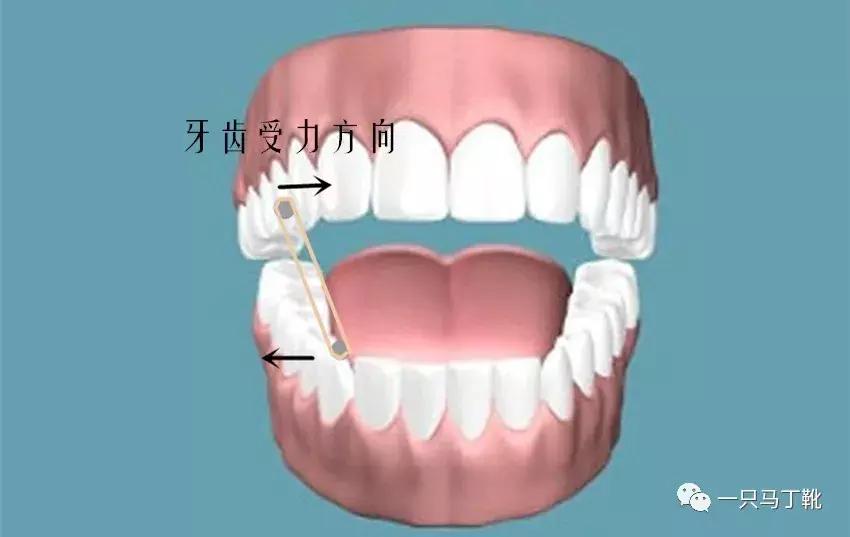 整牙一年半，这次重点说说整牙给我带来的小困扰