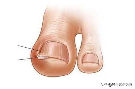 小脚趾甲沟炎自愈的十大方法,脚趾甲长进肉里怎么办修剪视频