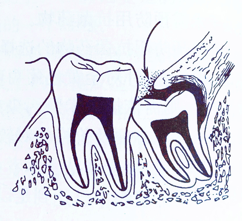 智齿发炎嘴巴张不开脸肿睡不着,智齿发炎脸硬怎么办