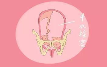 羊水栓塞不可怕,羊水栓塞难题解决
