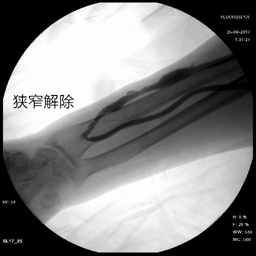 透析瘘口狭窄安支架能用多久,透析引起的上腔静脉狭窄怎么办