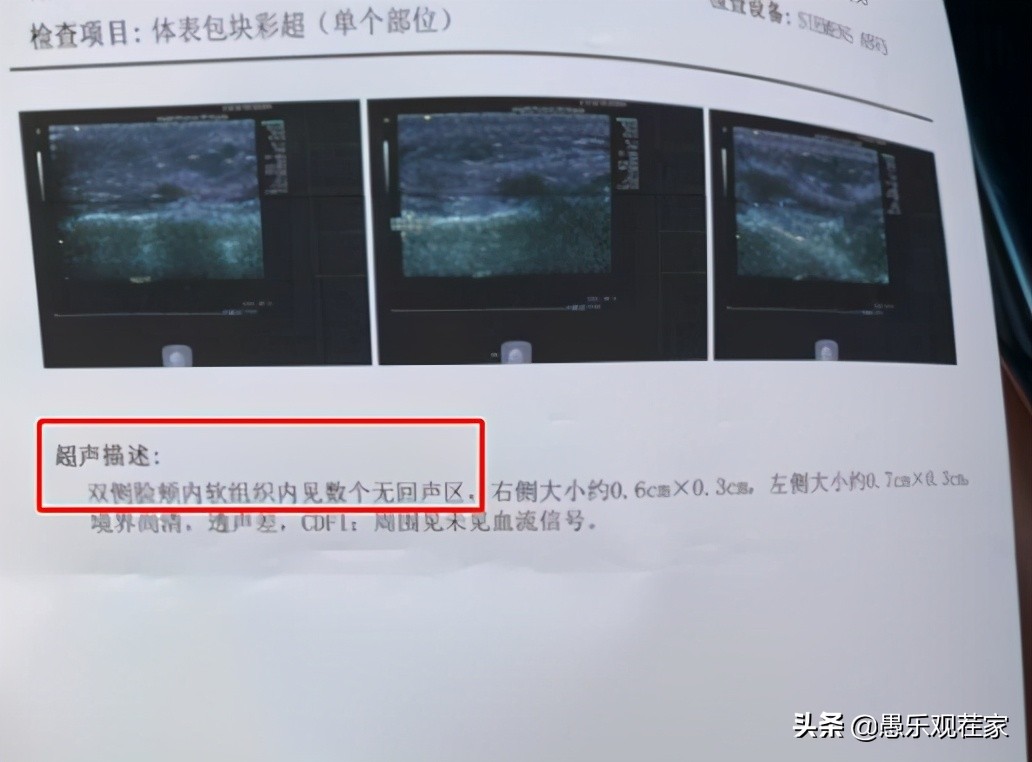 女子打童颜针长脓包3年没工作,女子打水光针花了17万