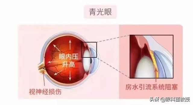 浙二眼科青光眼专家哪个好,青光眼能治好吗