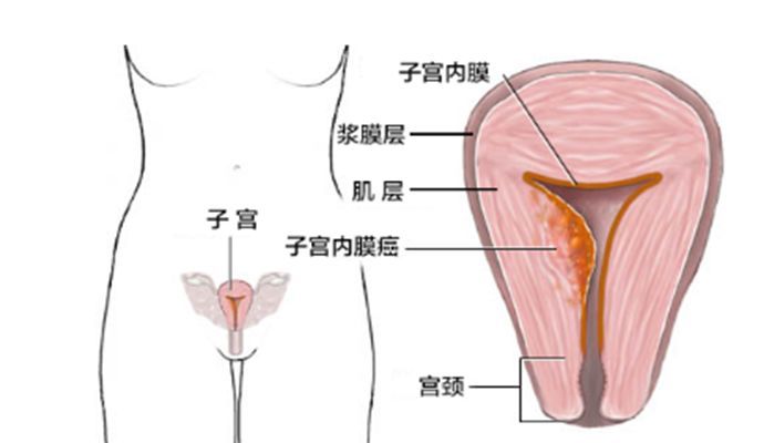 我都绝经12年了，怎么又出现流血了呢？这是咋回事？