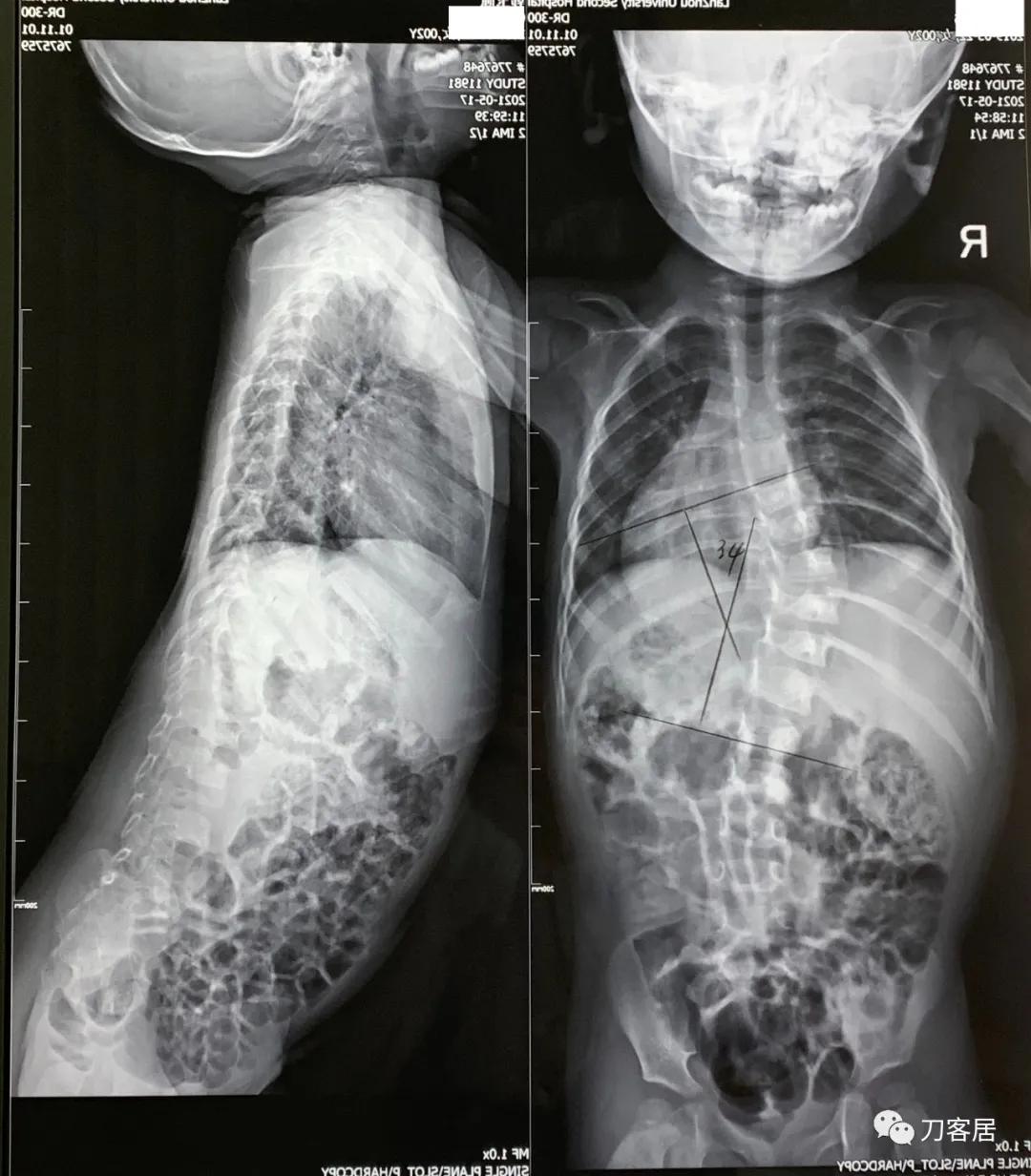我的门诊病历：家族性神经纤维瘤病性脊柱侧凸
