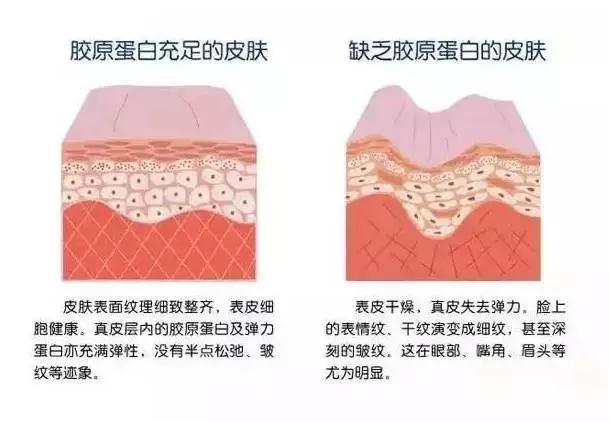 改善皮肤松弛下垂最有效方法,皮肤下垂显老态如何拯救