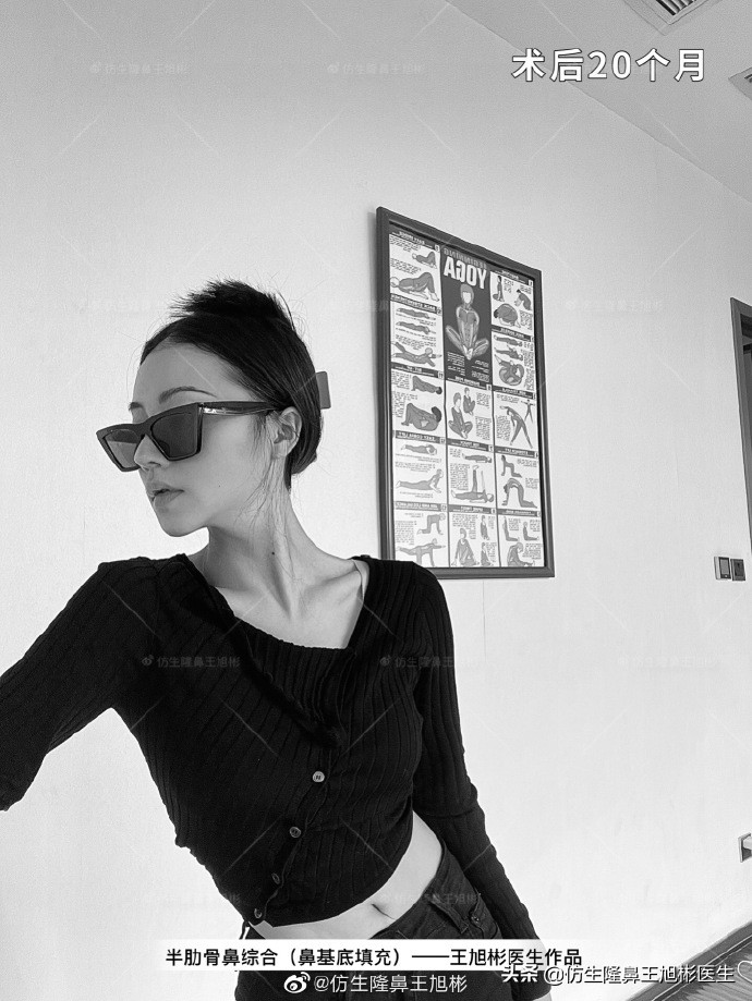 那些被鼻子“封印”颜值的鼻综合/修复案例|广州鼻整形