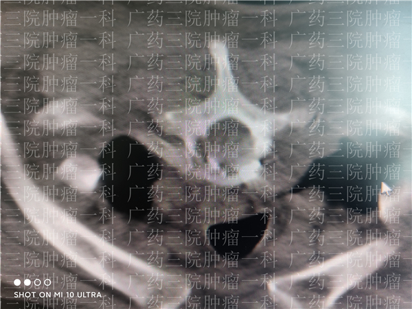 肺癌骨转移中药治疗成功案例,肺癌骨转移中医怎么治