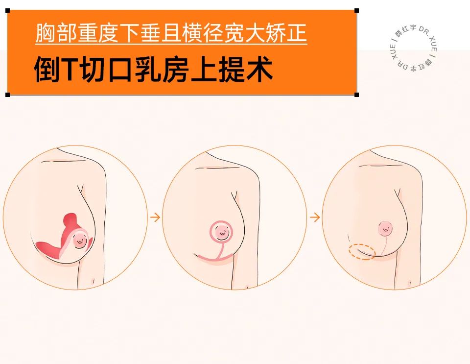 把胸往上提能治下垂吗,瑜伽可以使下垂的胸部上提吗