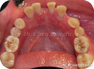 厦门种植牙陈松福,口腔正畸案例分享